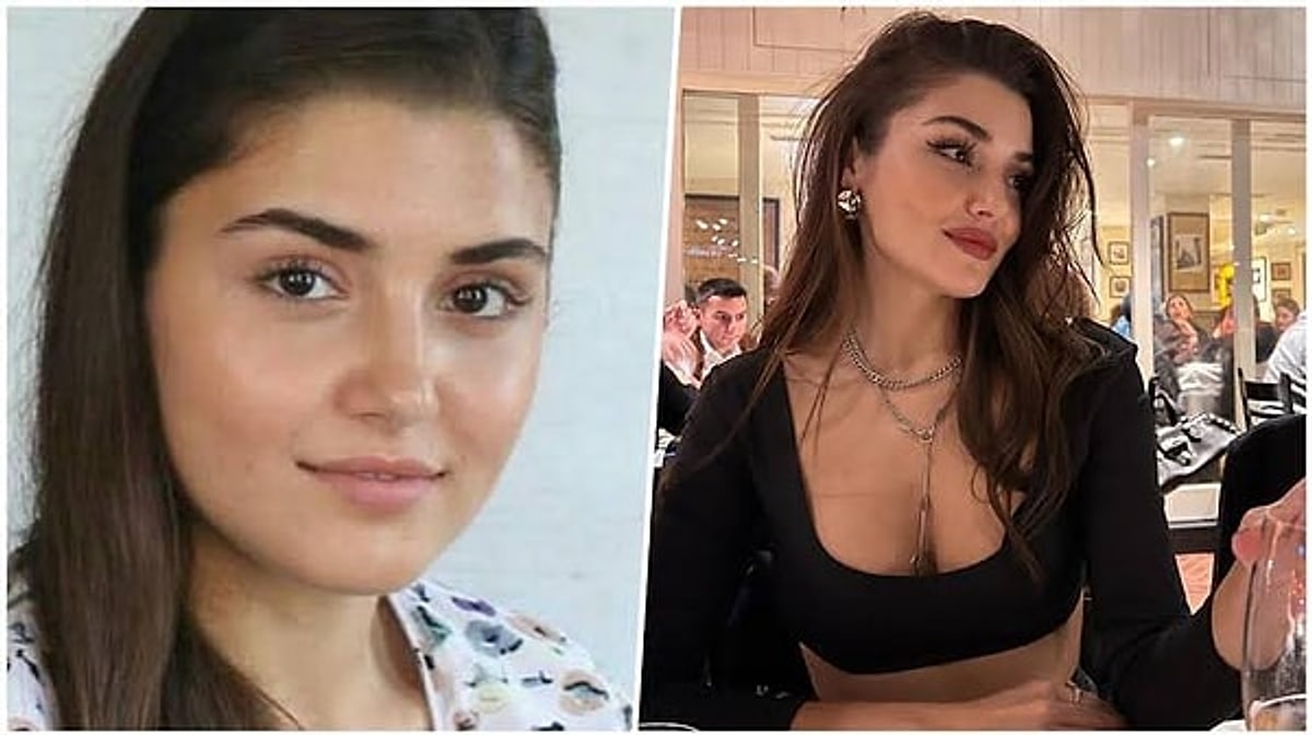 Hande Erçel’in Geçirdiği Estetik Operasyonları